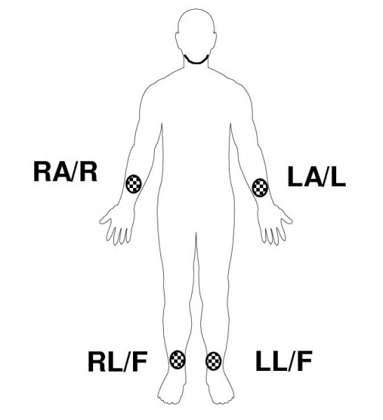 File:Cardiac Limb Lead Placement.jpg