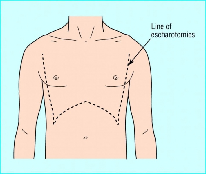 File:Escharotomy.jpg